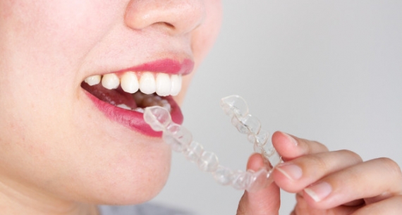 Invisalign®