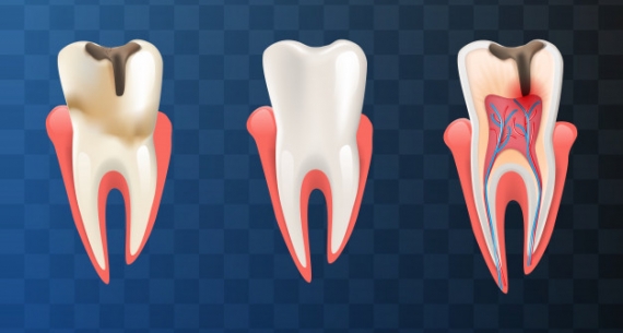 Root Canal Treatment Melbourne