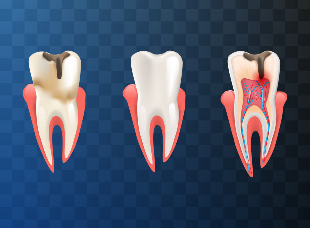 Root Canal Dentist Melbourne CBD | Root Canal Treatment Melbourne & VIC