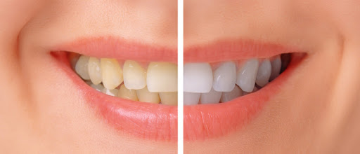 5 Habits That Can Stain Teeth